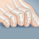 Claw Toes
